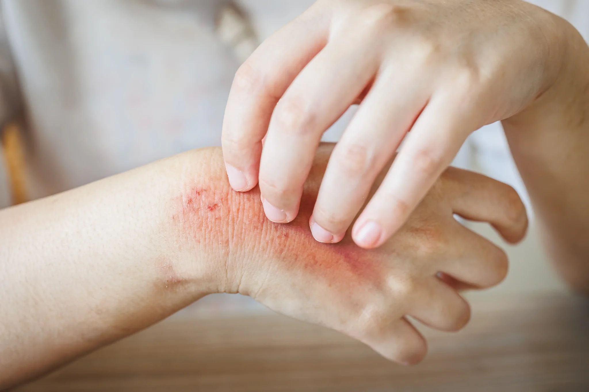 How to Say “Skin Rash” in Spanish: Useful Vocabulary and Examples